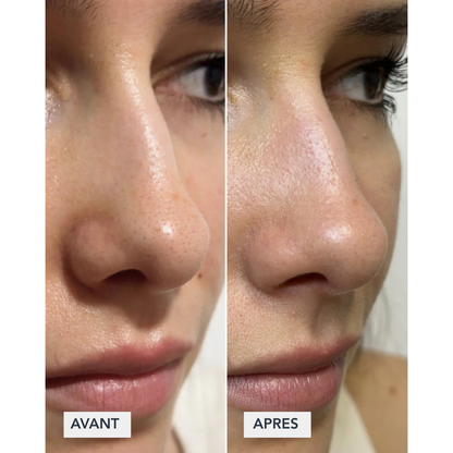 ClearSkin - Patch pour nez