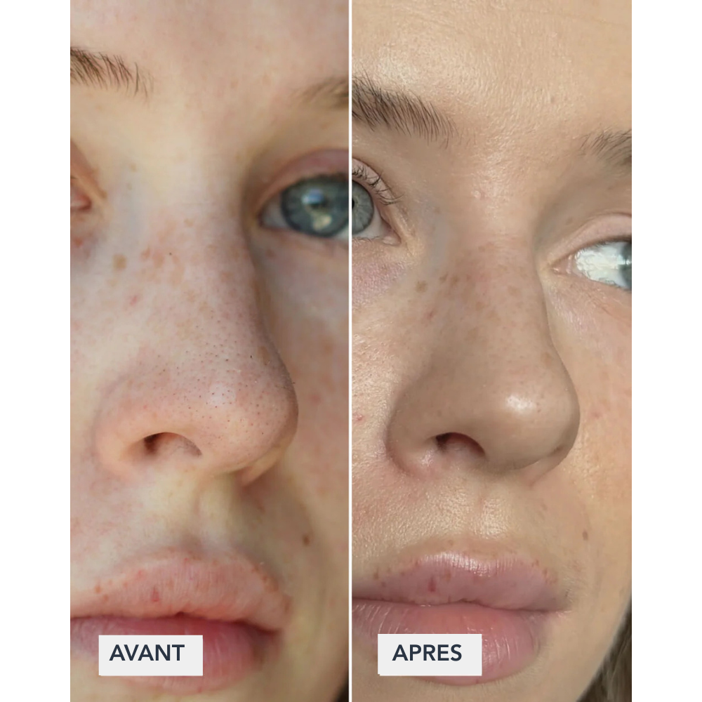 ClearSkin - Patch pour nez