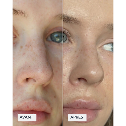 ClearSkin - Patch pour nez